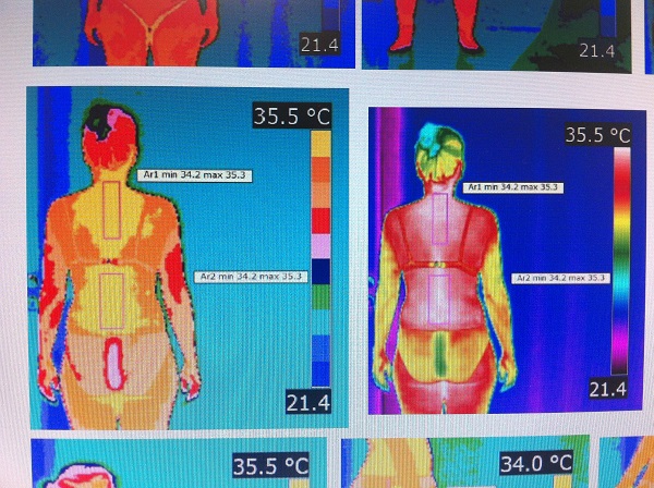 Estudio de fibromialgia y alteración de la temperatura corporal Estudio de fibromialgia y alteración de la temperatura corporal