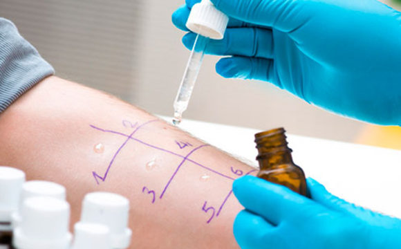 Pruebas de alergia Pruebas de alergia