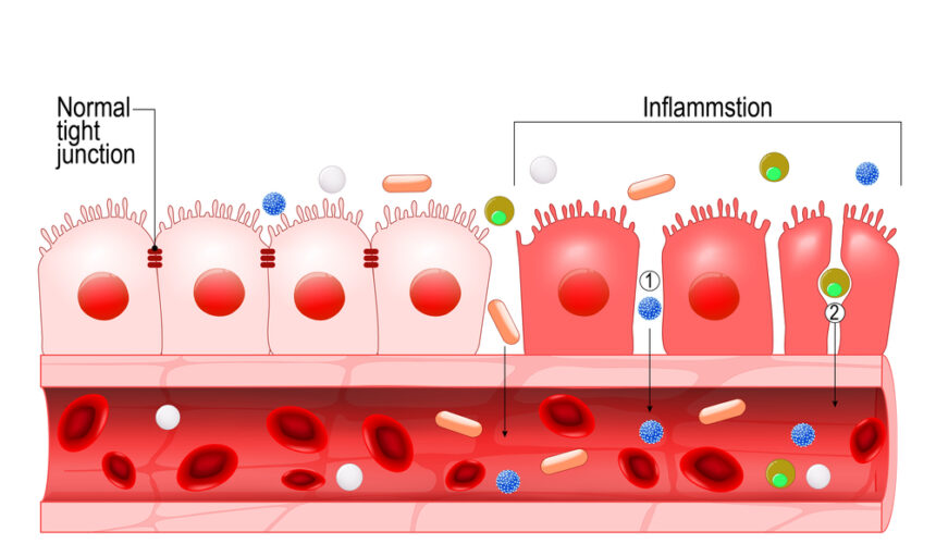 Síndrome del intestino permeable o leaky gut Síndrome del intestino permeable o leaky gut